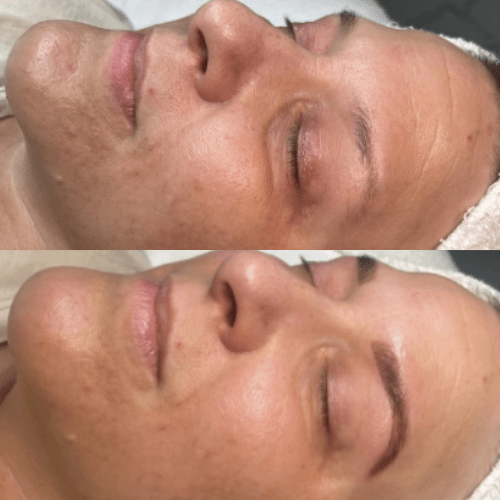 Anti-Aging Facials