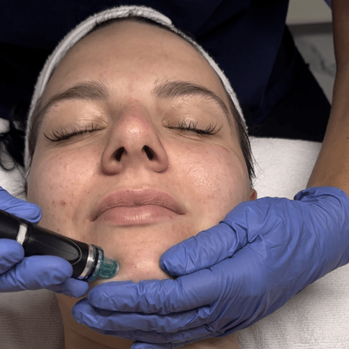 HydraFacial