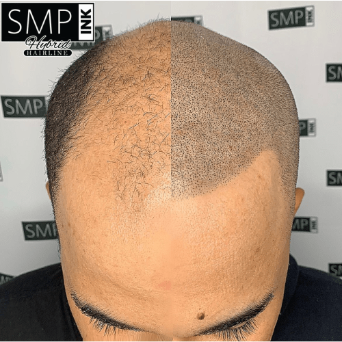 Scalp Micropigmentation
