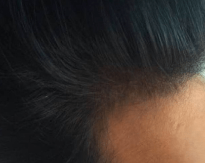 SCALP MICROPIGMENTATION