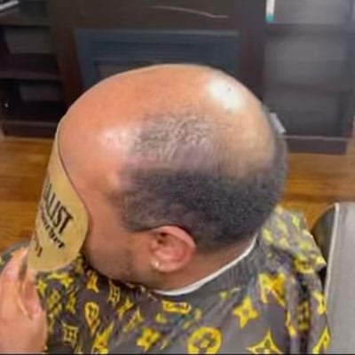 HAIR LOSS SOLUTION
