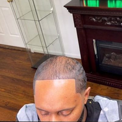 ALOPECIA TREATMENT