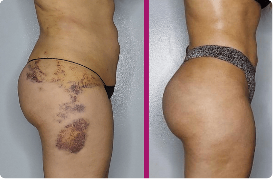  Post-Op Lymphatic Drainage