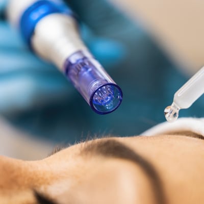 PRP MICRONEEDLING