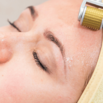 MICRONEEDLING