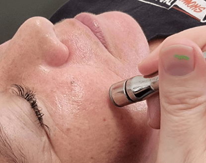 MICRODERMABRASION FACIAL