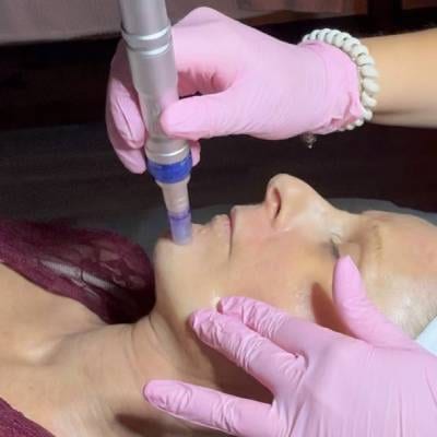 MICRONEEDLING