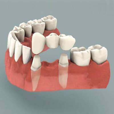 DENTAL BRIDGES