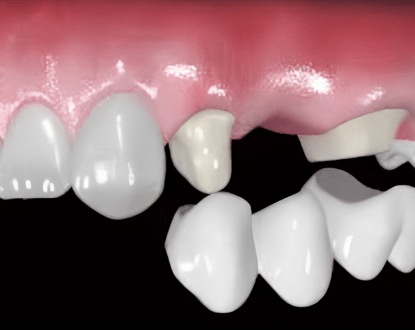 DENTAL CROWNS
