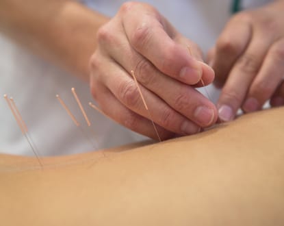 ACUPUNCTURE