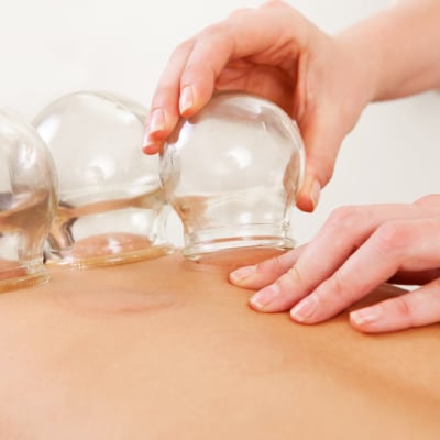 CUPPING THERAPY