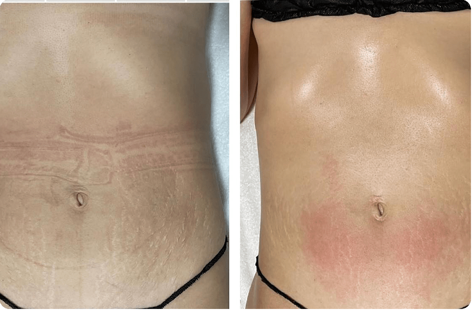 Post-Op Lymphatic Drainage