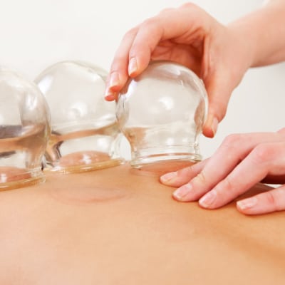 CUPPING THERAPY