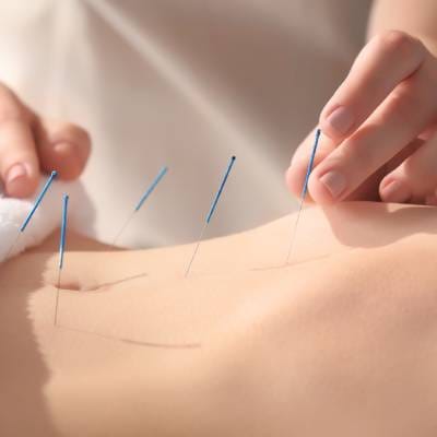 ACUPUNCTURE