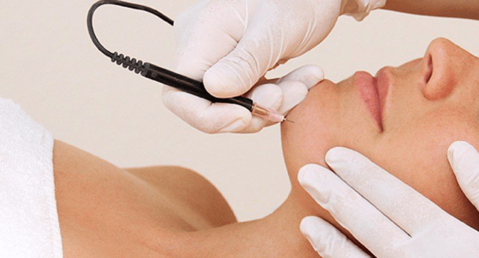 Electrolysis Hair Removal