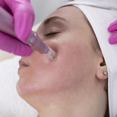 MICRONEEDLING SERVICES