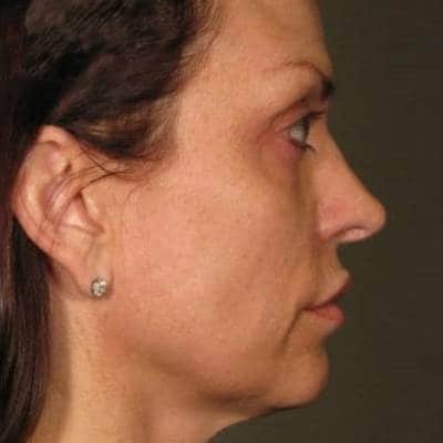 NON-SURGICAL FACELIFT