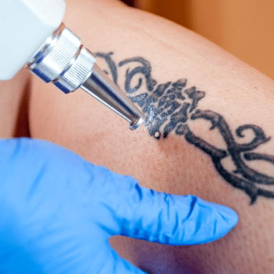 TATTOO REMOVAL