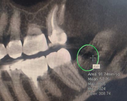 BONE CAVITATION TREATMENT