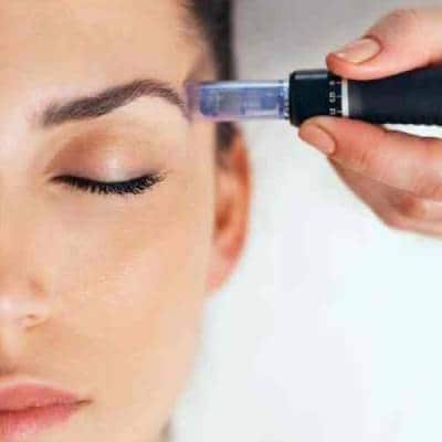 MICRONEEDLING SERVICES
