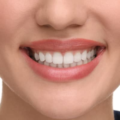 TEETH WHITENING SERVICE