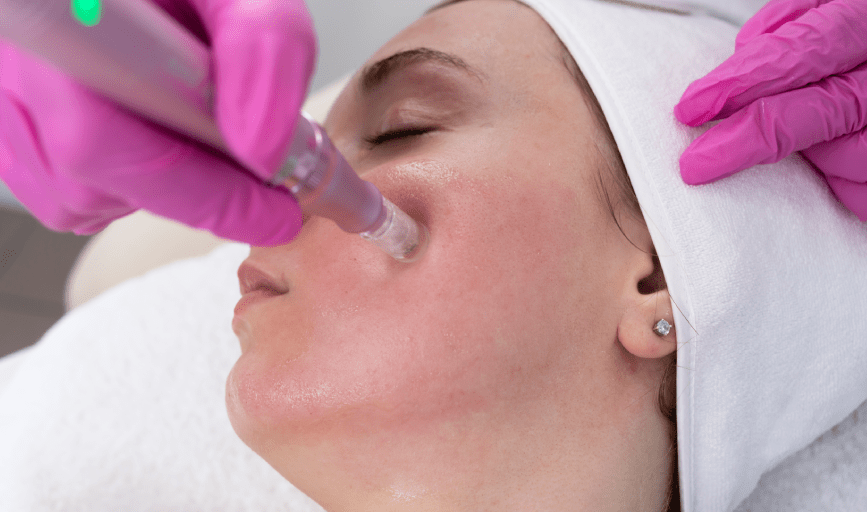 VAMPIRE FACIAL SERVICE