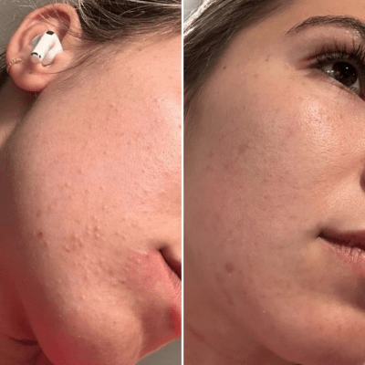 DEEP CLEANSING FACIALS