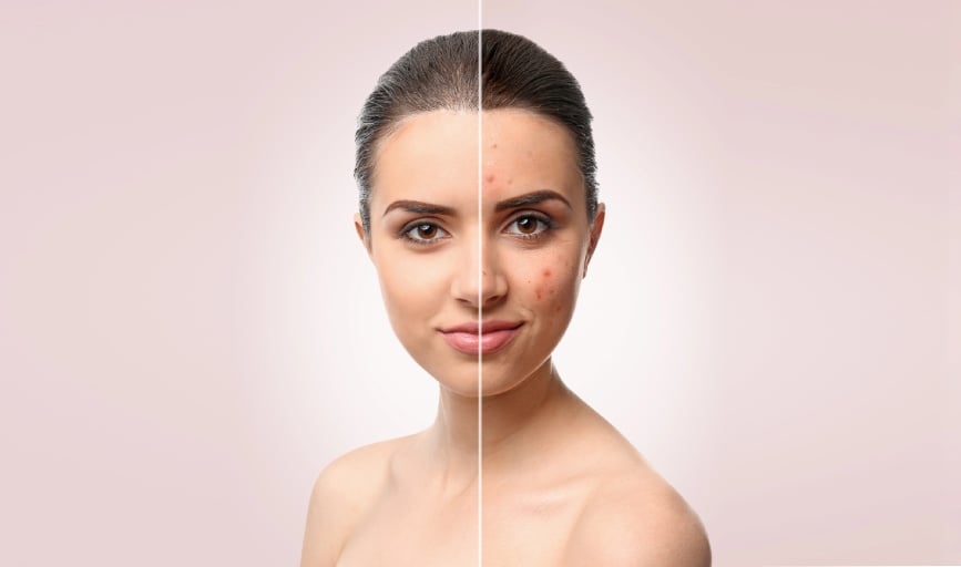 ACNE TREATMENT FACIAL