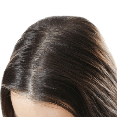  HAIR LOSS TREATMENT