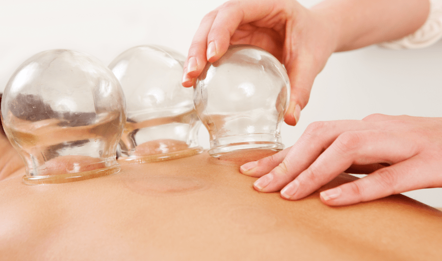 CUPPING THERAPY