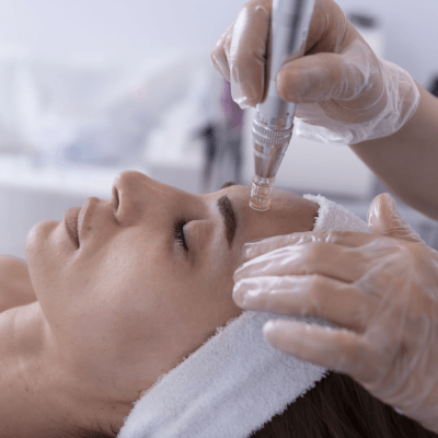 MICRONEEDLING