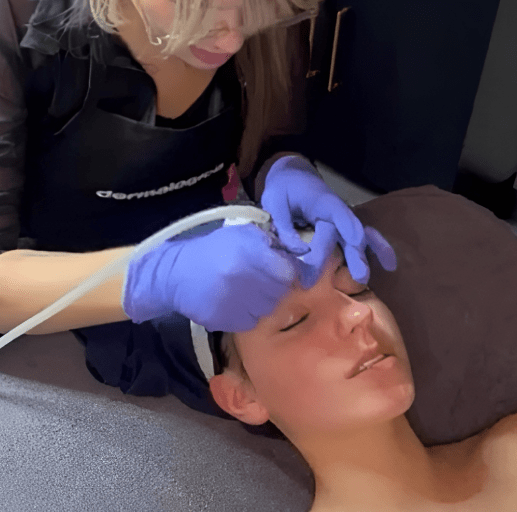 MICRONEEDLING