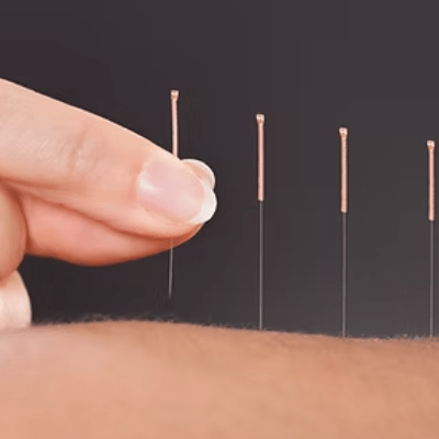 ACUPUNCTURE