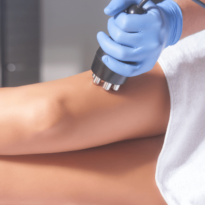 RADIOFREQUENCY SKIN TIGHTENING