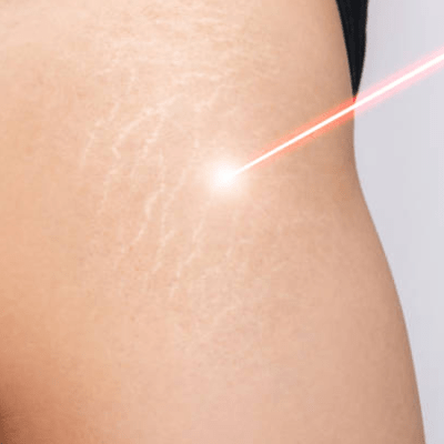 STRETCH MARK REMOVAL