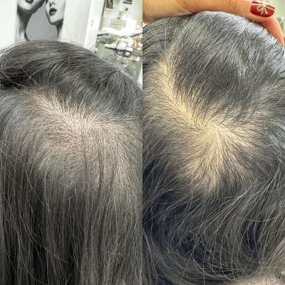 SCALP MICROPIGMENTATION