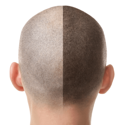 SCALP MICROPIGMENTATION