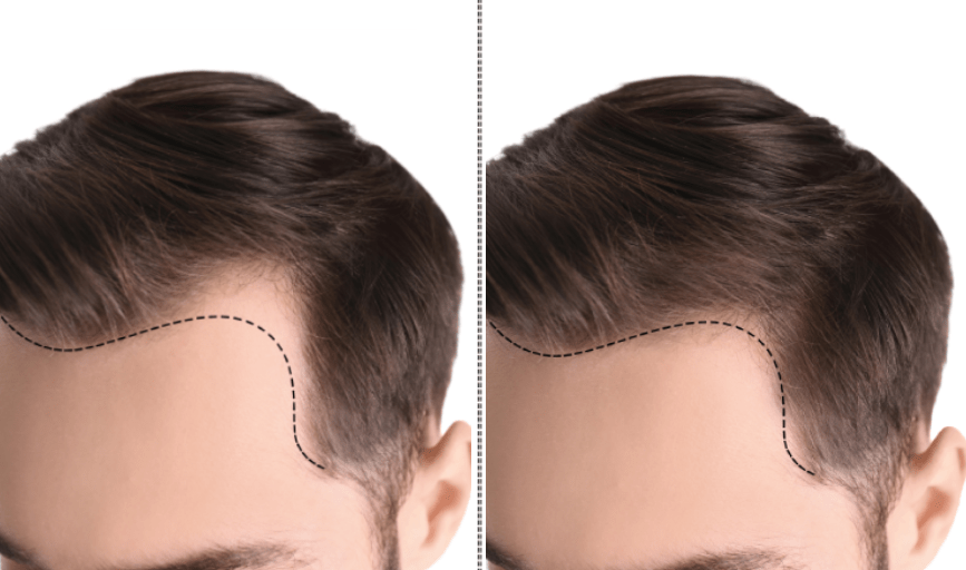 SCALP MICROPIGMENTATION SERVICE
