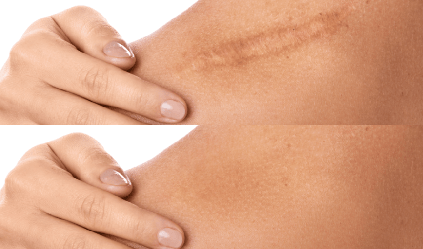 SCAR REVISION SERVICE