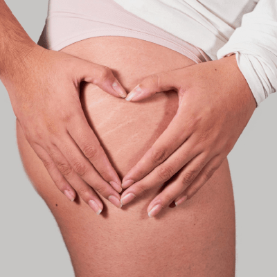 STRETCH MARK CAMOUFLAGE