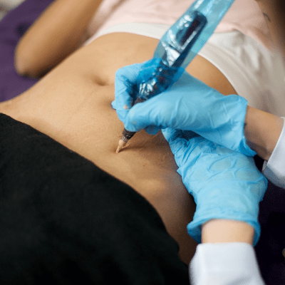 SURGICAL SCAR CAMOUFLAGE