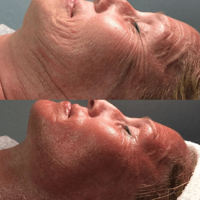 CRYO-FACIALS