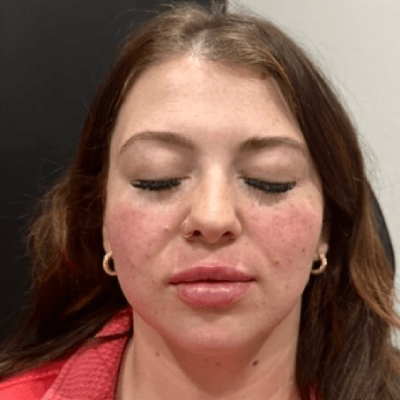 LIP FILLERS