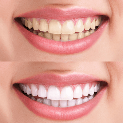 TEETH WHITENING