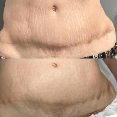 SCAR CAMOUFLAGE TATTOO