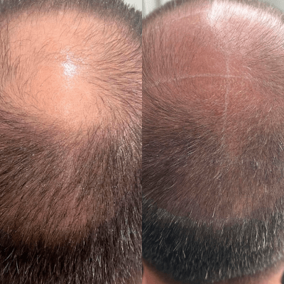 HAIR LOSS THERAPY