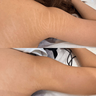 STRETCH MARK REVISION