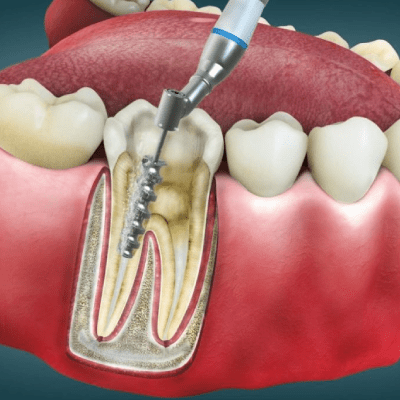 ROOT CANALS
