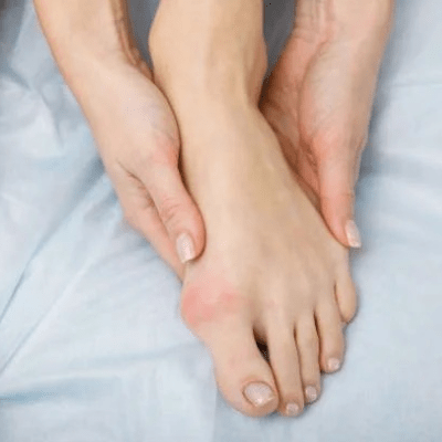 BUNION TREATMENT