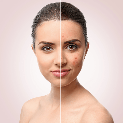 ACNE FACIAL TREATMENT